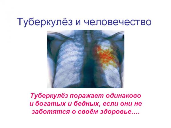 Туберкульоз