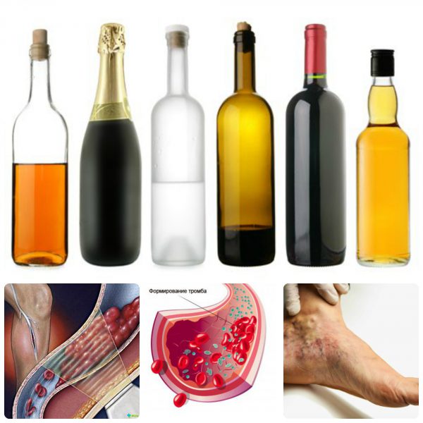 varicose veins and alcohol