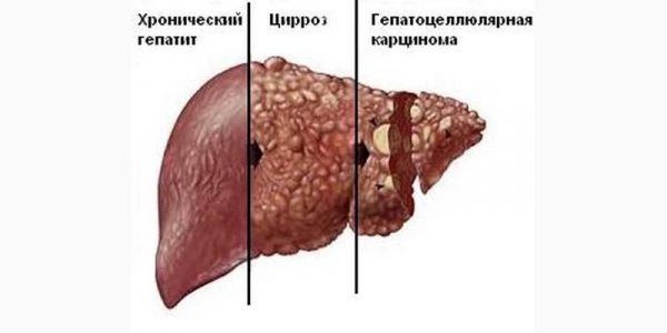 cirrhosis is cancer