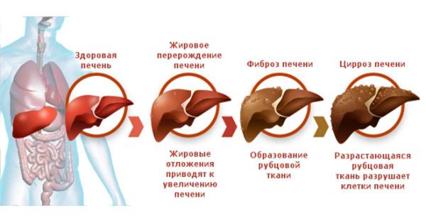 Causes of liver damage from alcohol