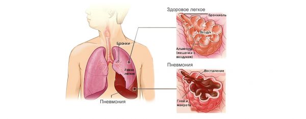 Пневмонія