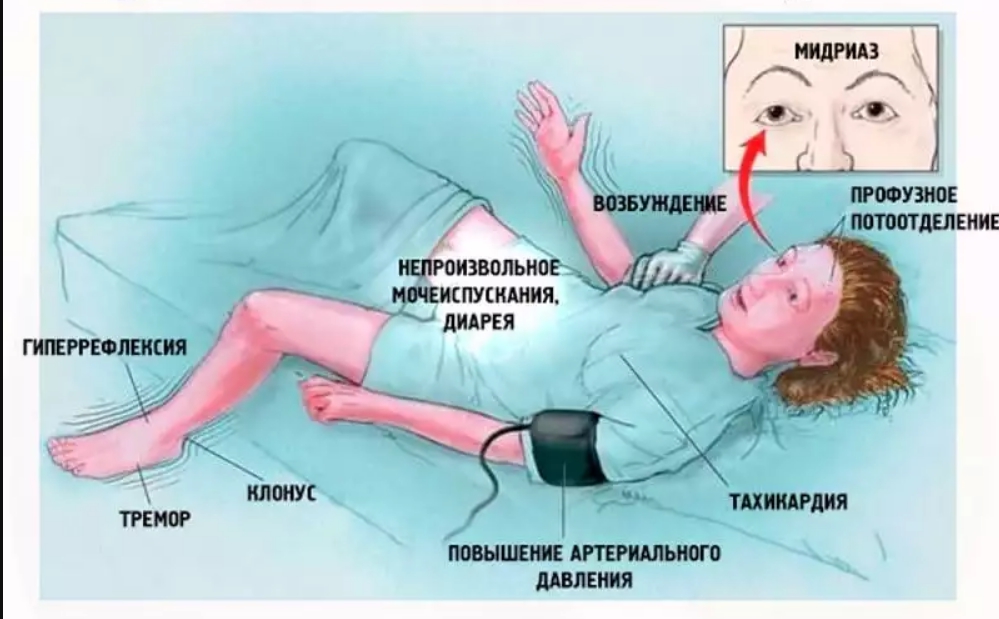 Клиническая картина поли х синдрома у женщин характеризуется