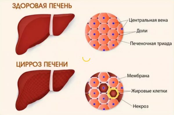 На фото показан внешний вид и отличия больного циррозом печени, от здоровой печени, какие изменения происходят на клеточном уровне - появляются жировые клетки и некроз.
